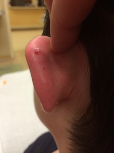 back of girl's ear with infected piercings after earrings were removed