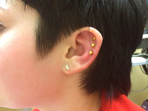 girl's ear with infected piercings in cartilage with earrings in
