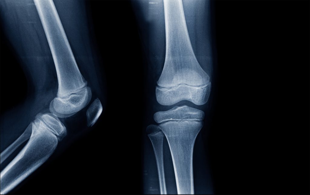 Growth Plate Injuries