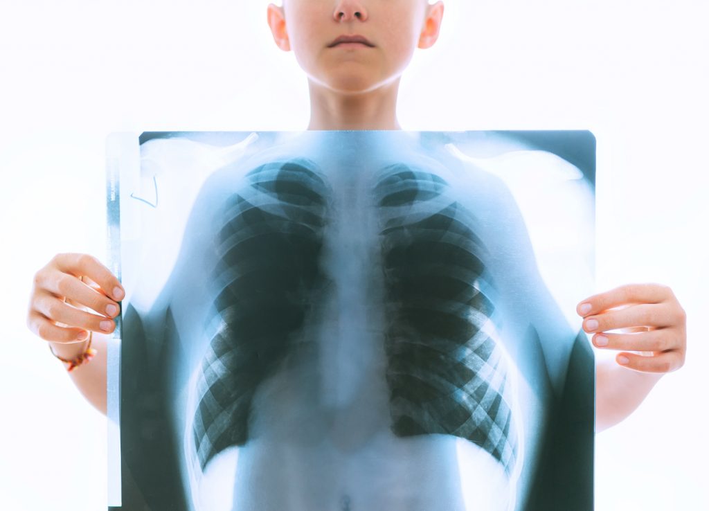 Kid holds x-ray showing lungs during COVID-19 pandemic